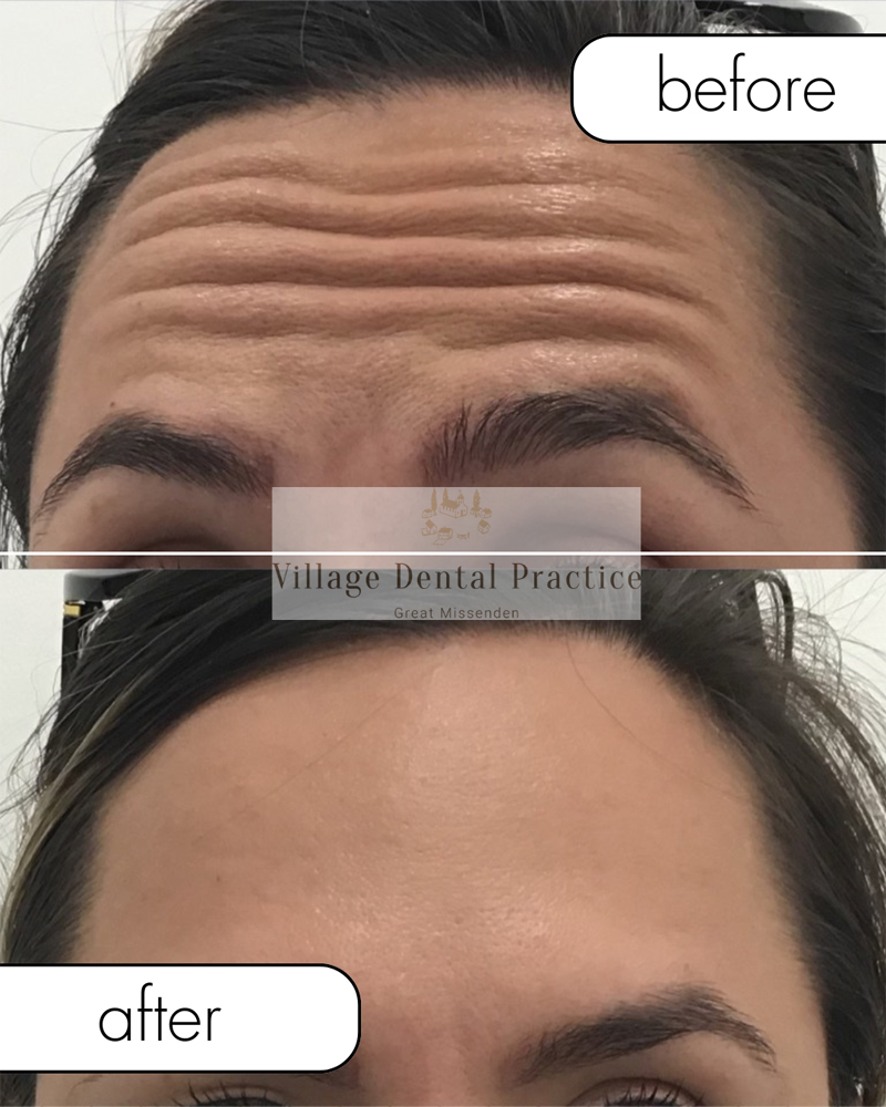 before after anti-wrinke injections