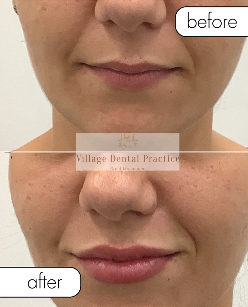 before after fillers