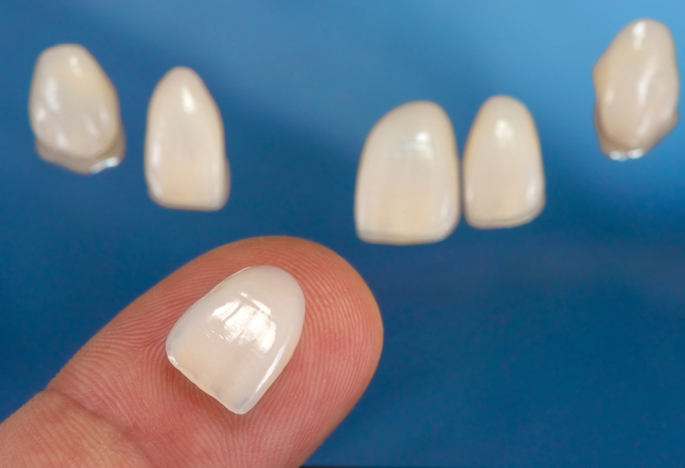 How can Veneers help me?