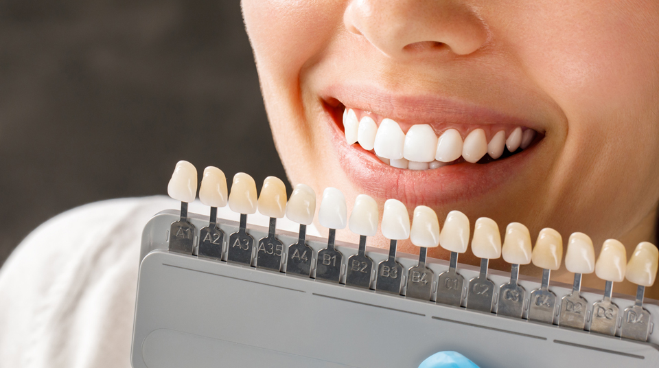 The Benefits of Veneers