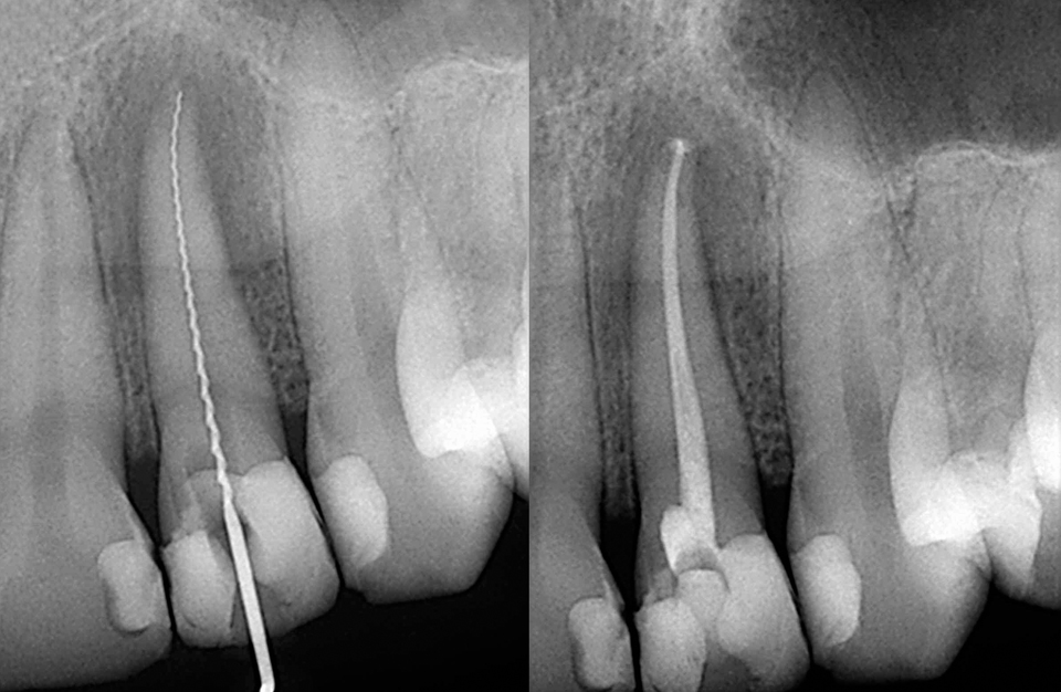 What are the Benefits of Root Canal Treatment?