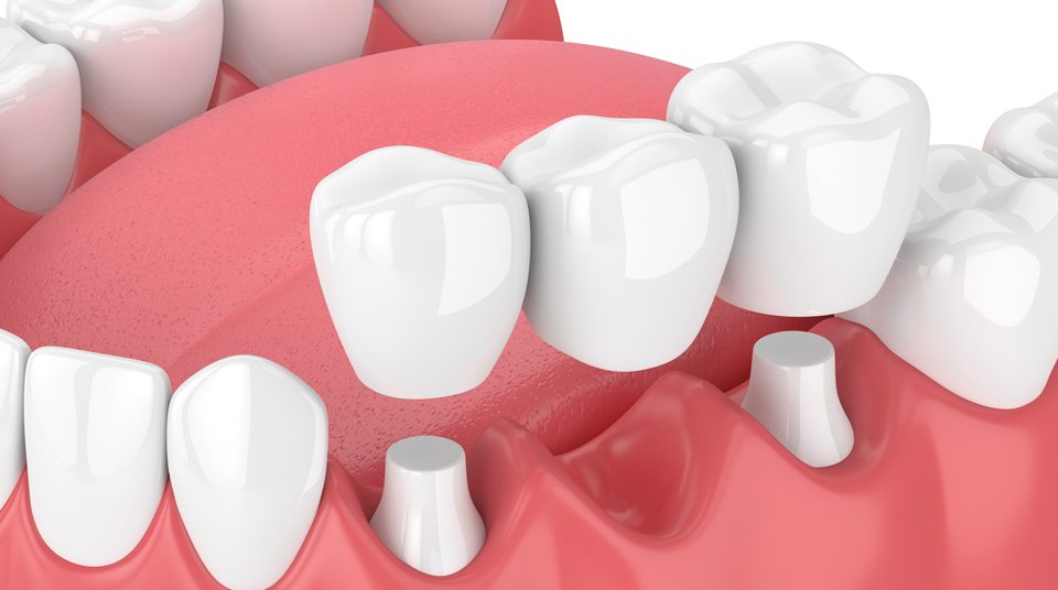 What is a Dental Bridge?