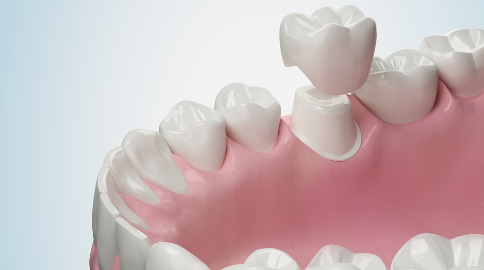 What is a Dental Crown?