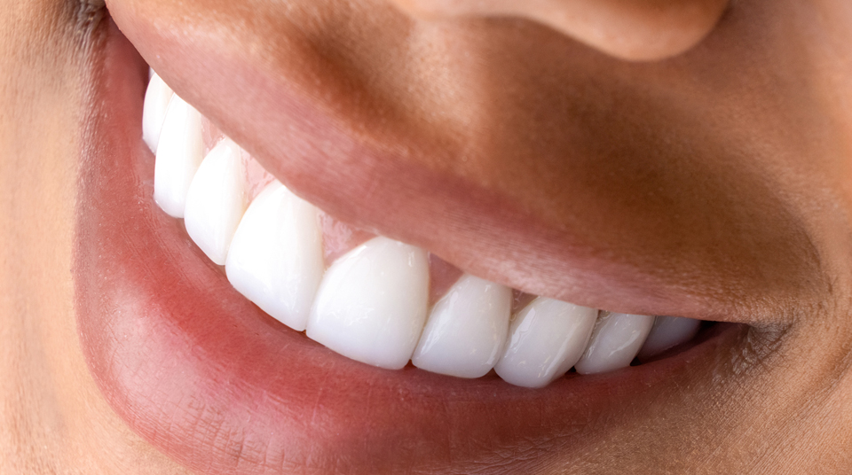 What is Composite Bonding?