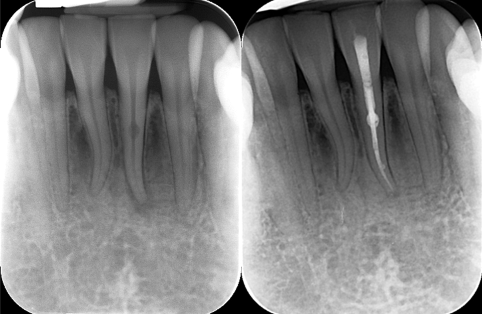 What are the Benefits of Root Canal Treatment?